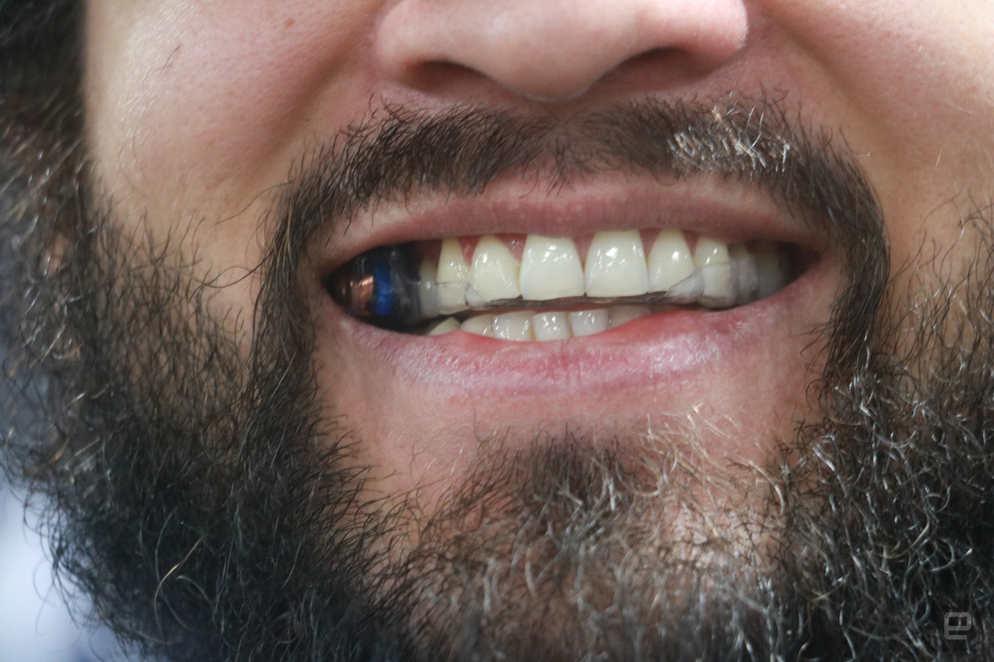 Close-up of a person's smile using the MouthPad 2024. Some lines indicate that the person has a clear tray over their teeth, while a small piece of equipment is on top of a tooth on the right side of the mouth.